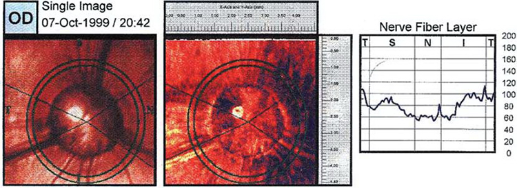Изображение глаукоматозного глаза собаки, полученное при СЛП. Nerve Fiber Layer – слой нервных волокон. [21]