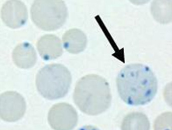 Рис.3. Стрелкой отмечен зернистый ретикулоцит (окраска на ретикулоциты). Крупные синие точки в других эритроцитах – тельца Хайнца (но это уже совсем другая история).