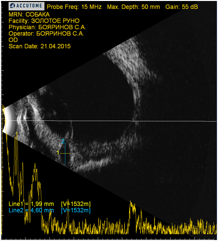 Рисунок 5. Ультразвуковая картина глаза при ПУГ. Скопление ВГЖ (анэхогенный участок) в задней камере глаза.