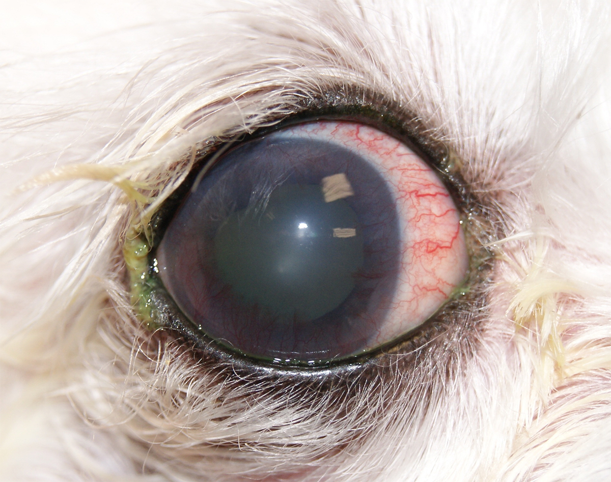 Вторичная глаукома, вызванная набуханием хрусталика, ВГД – 40 мм рт.ст.