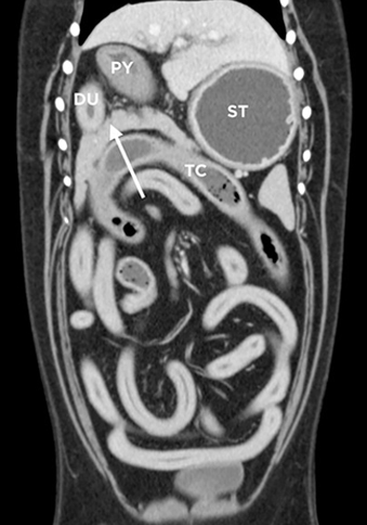 РИСУНОК 7. Дорсальный КТ-скан брюшной полости собаки: визуализируются тело, правая и левая доли поджелудочной железы. 
