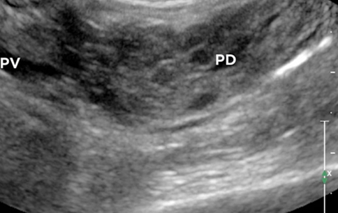 РИСУНОК 9. Поперечное сканирование левого эпигастрия возрастной кошки: левая доля поджелудочной железы с узловой гиперплазией изображена в длинной оси. 