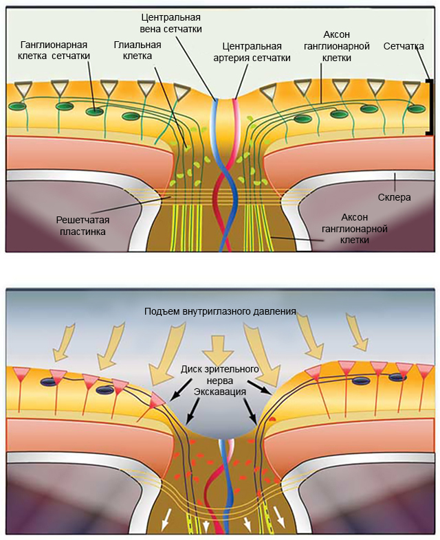 Схематическое изображение воздействия ВГД на сетчатку и зрительный нерв