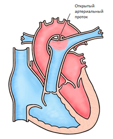 Открытый артериальный  (Боталлов) проток