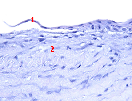 Рис. 2. Микрокартина роговицы глаза с образованием патологического эпителия: 1 – патологический эпителий; 2 – строма роговицы.